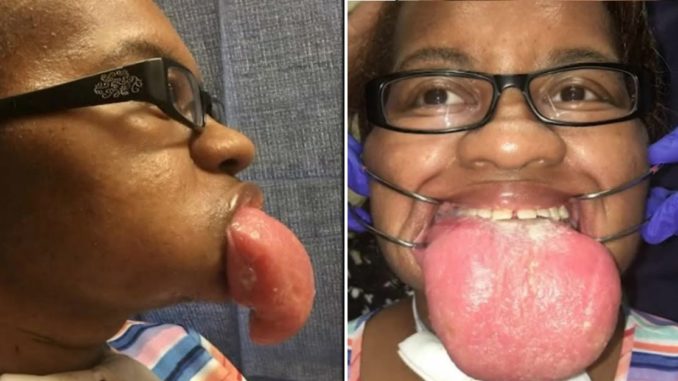 Doctors In Houston Are Investigation Why Some COVID Patients Develop Massively Enlarged Tongues