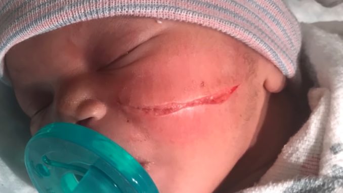 Newborn Baby in Denver Gets Massive Gash On Her Face From C-Section Scalpel; Requiring 13 Stitches