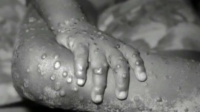 United Arab Emirates Announces First Known Case of Monkeypox