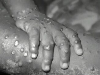 Monkeypox Now Detected in 7 States