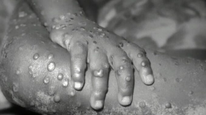 Monkeypox Now Detected in 7 States