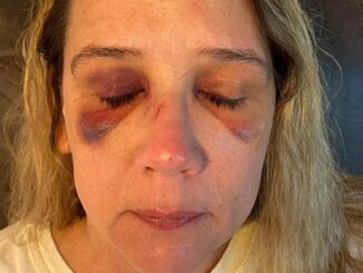 Mother Left With 2 Black Eyes After Being Brutally Beaten by Teens Girls Wanting to Fight Her Daughter