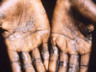 CDC Tells Monkeypox Patients to Keep Their Clothes on When Having Sex