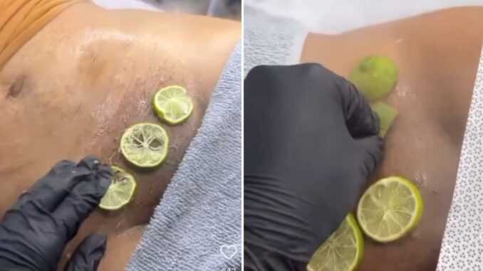 Woman Gets Lemon Lime Juice & Aloe Vera Applied After Brazilian Wax!