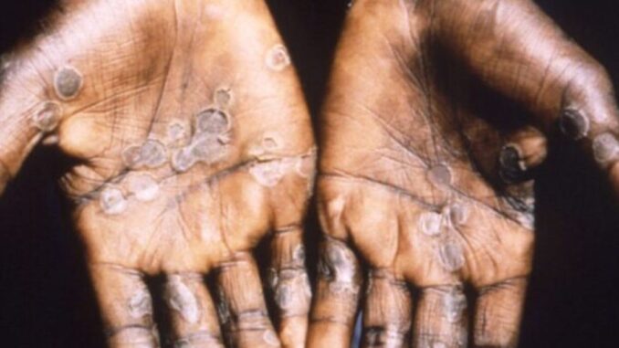 World Health Organization Declares Monkeypox Outbreak a Global Emergency!
